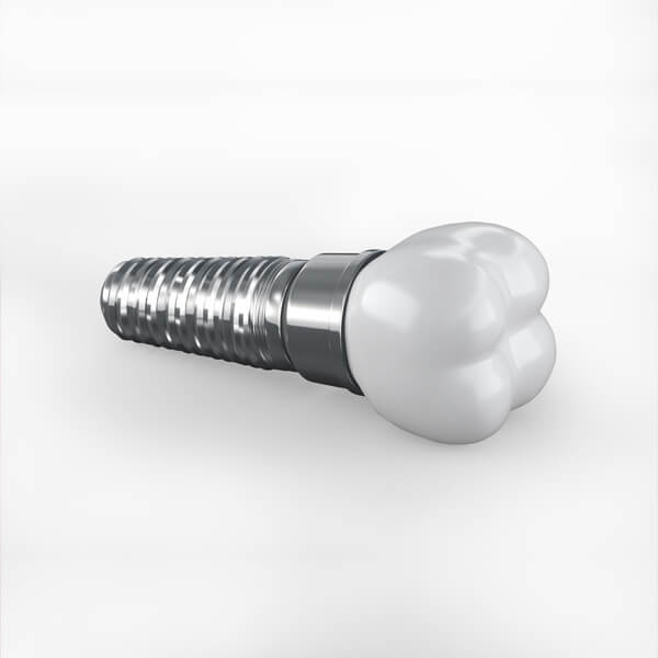 dental implant