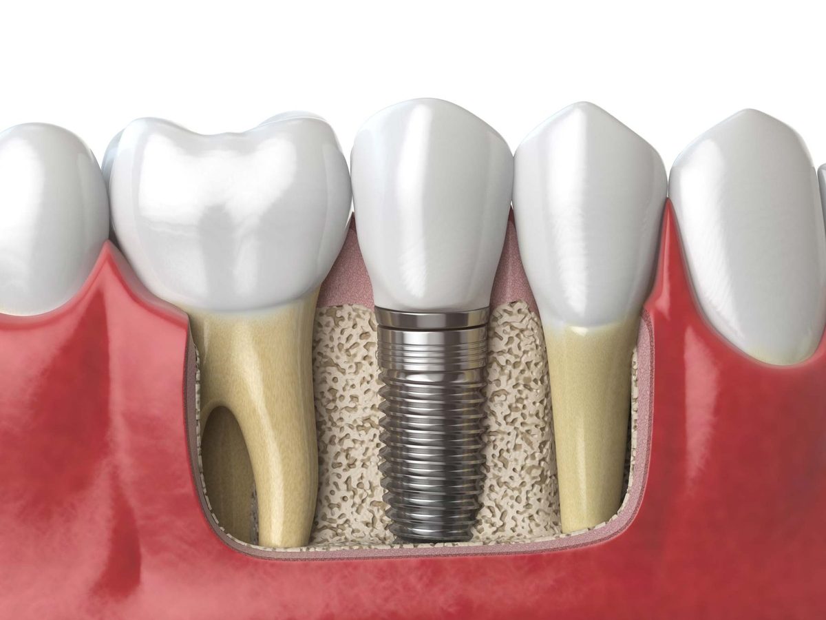 Cross-section illustration of a titanium dental implant set into the jawbone between two natural teeth, with a crown on top
