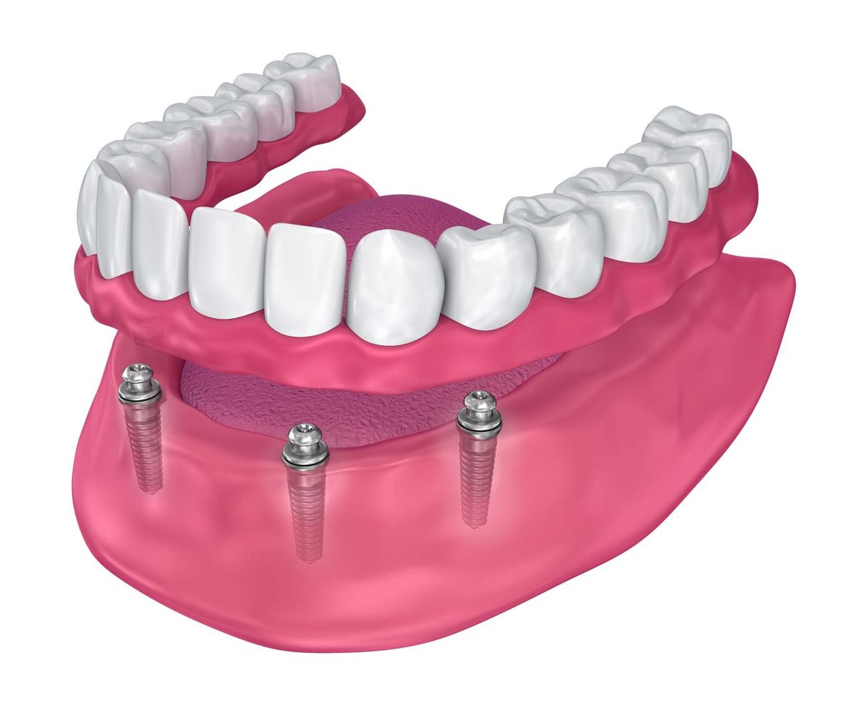 Illustration of a full arch of fixed teeth held on four angled dental implants